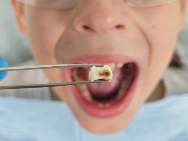 Best Emergency Dental Care for Broken or Chipped Teeth in Wailua Homesteads, HI